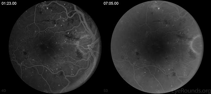 There is early punctate hyperfluorescence distributed throughout the macula. There is early peri-foveal staining with surrounding hypofluorescence which remains stable into the late frames.