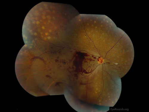 right eye. Neovascularization of the disc with preretinal hemorrhage anterior to the macula and throughout the inferior and temporal periphery with moderate panretinal photocoagulation scars diffusely