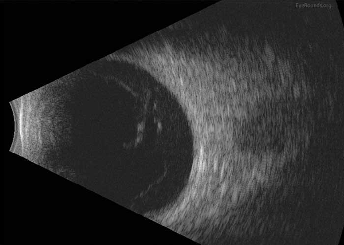 Right eye. Dense, dispersed vitreous hemorrhage. Dense subvitreal hemorrhage. Extensive posterior vitreous detachment with tractional insertions superiorly and around optic disc. No retinal detachment detected. 