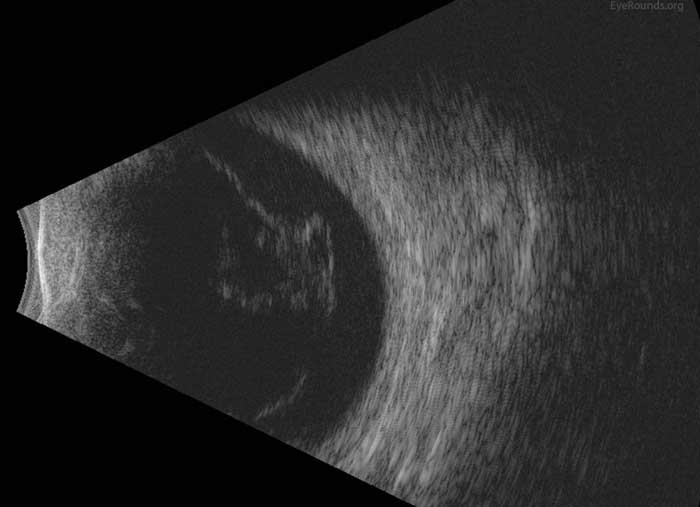 left eye: Moderately dense, dispersed vitreous hemorrhage. Total, mobile posterior vitreous detachment. No traction or retinal detachment detected.