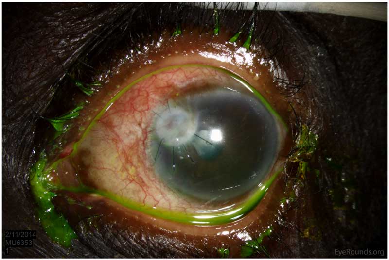 Mini penetrating keratoplasty