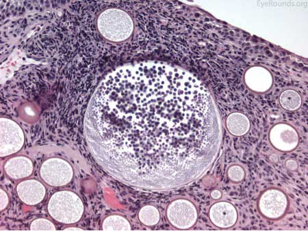 Mature sporangium containing and releasing endospores