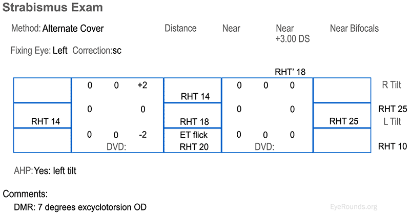 The strabismus measurements showing a right hypertropia (RHT) in primary position that worsens in adduction (left gaze) and also in right head tilt. There is right superior oblique underaction and right inferior oblique overaction, as well as 7 degrees of excyclotorsion on double Maddox rod (DMR).