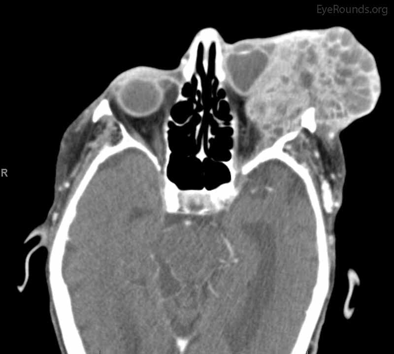 Coronal, frontal, and sagittal views from CT maxillofacial with contrast at the time of follow-up, The CT demonstrates massive interval growth of the left orbital mass displaying both solid enhancing and cystic components. The epicenter of the mass appears to be in the left lacrimal gland There is marked left proptosis with compression and deformation of the left globe as well as medial displacement of the optic nerve and extraocular muscles. There is no definite sign of osteolysis of the orbital walls, however, there is bone remodeling with depression of the orbital floor. No evidence of intracranial extension of the left orbital mass.