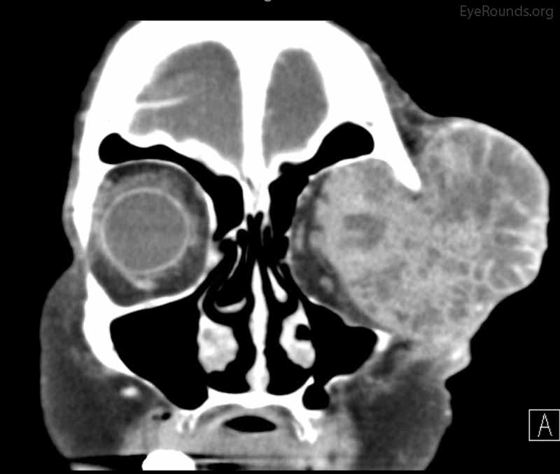 Coronal, frontal, and sagittal views from CT maxillofacial with contrast at the time of follow-up, The CT demonstrates massive interval growth of the left orbital mass displaying both solid enhancing and cystic components. The epicenter of the mass appears to be in the left lacrimal gland There is marked left proptosis with compression and deformation of the left globe as well as medial displacement of the optic nerve and extraocular muscles. There is no definite sign of osteolysis of the orbital walls, however, there is bone remodeling with depression of the orbital floor. No evidence of intracranial extension of the left orbital mass.