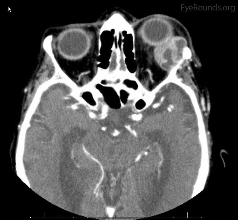 Coronal, frontal, and sagittal views from CT maxillofacial with contrast at the time of initial presentation. The CT demonstrates a left orbital mass displaying both solid enhancing and cystic components. The epicenter of the mass appears to be in the left lacrimal gland. There is left proptosis with medial displacement of the optic nerve and extraocular muscles. There is no definite sign of osteolysis of the orbital walls, however, there is bone remodeling with depression of the orbital floor. No evidence of intracranial extension of the left orbital mass.