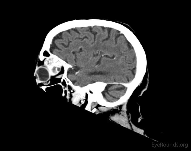 Coronal, frontal, and sagittal views from CT maxillofacial with contrast at the time of initial presentation. The CT demonstrates a left orbital mass displaying both solid enhancing and cystic components. The epicenter of the mass appears to be in the left lacrimal gland. There is left proptosis with medial displacement of the optic nerve and extraocular muscles. There is no definite sign of osteolysis of the orbital walls, however, there is bone remodeling with depression of the orbital floor. No evidence of intracranial extension of the left orbital mass.