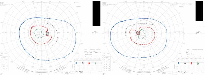 Goldman perimetry OD and OS shows a subtle right superior homonymous quadrantanopia to the I1e (green) isopter.