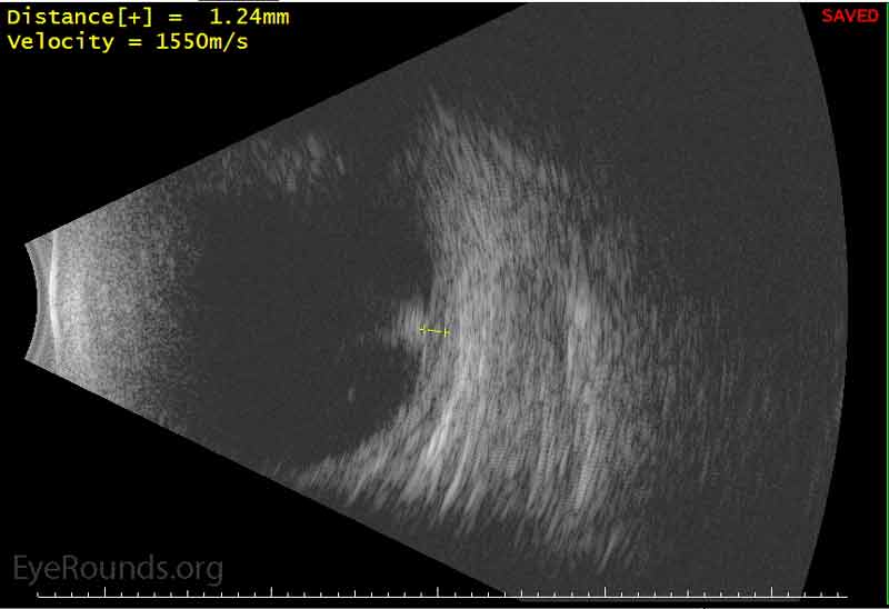 Left Eye, B-scan of elevated peripheral VPT. The lesion was found to have medium to high internal reflectivity and measured 1.44 mm (height) by 7.8 mm (base).