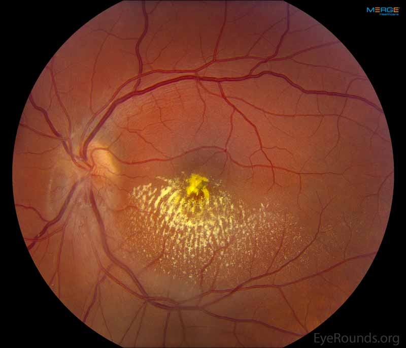 Left Eye, Color fundus photo 5 months after presentation following intravitreal bevacizumab and focal laser.