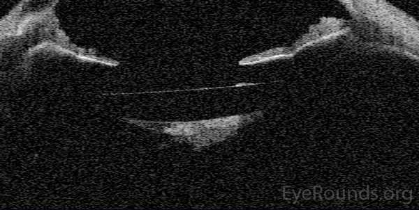 An anterior segment optical coherence tomography (AS-OCT) of the right eye demonstrates late capsular block post-YAG capsulotomy