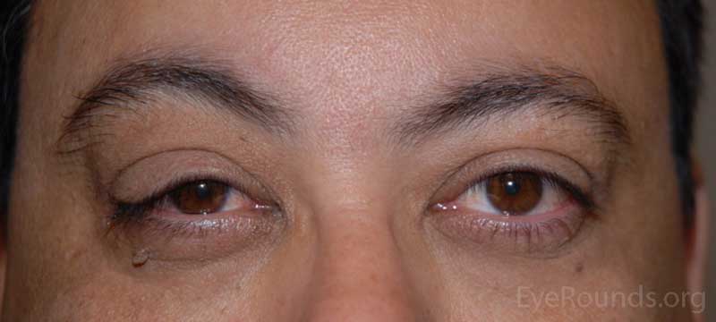 OD: lateral ptosis, significant eversion of the upper eyelid with minimal upward traction; significant lower eyelid laxity 