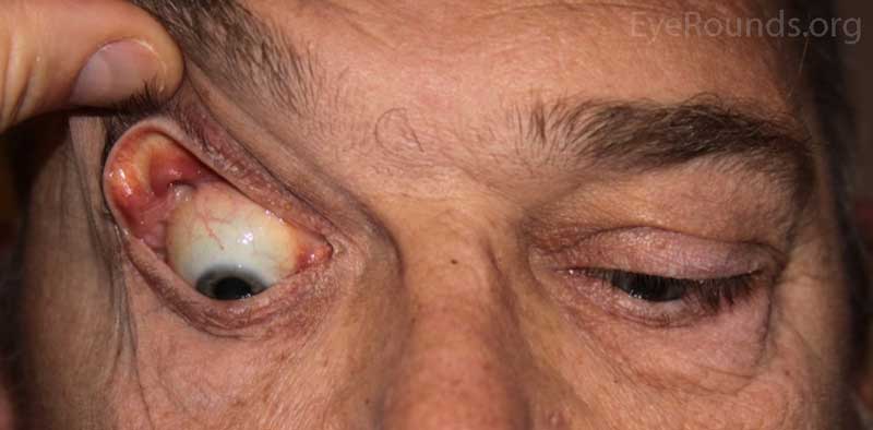 OD: Ptosis, significant eversion with gentle traction on the upper eyelid