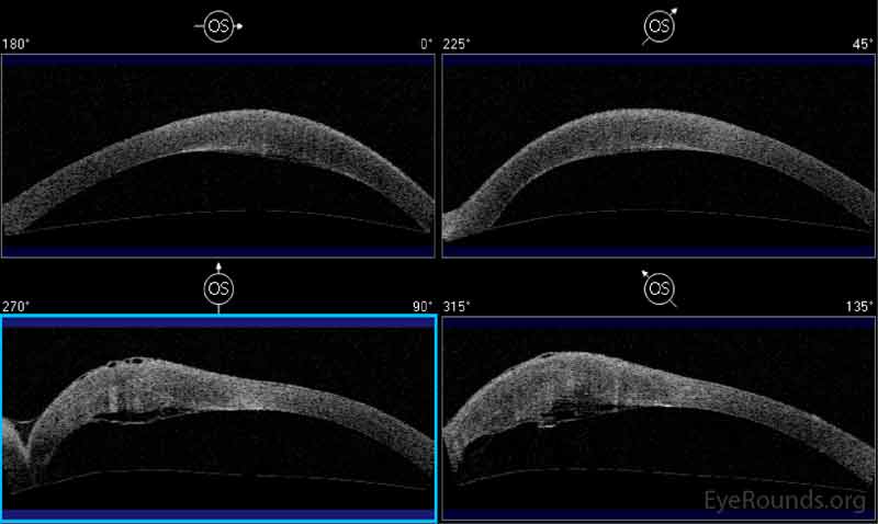 Figure 2: Anterior segment OCT showing massive inferior corneal edema and overlying epithelial bullae. A break in Descemet's membrane with Descemet's membrane detachment is visible below the area of edema.