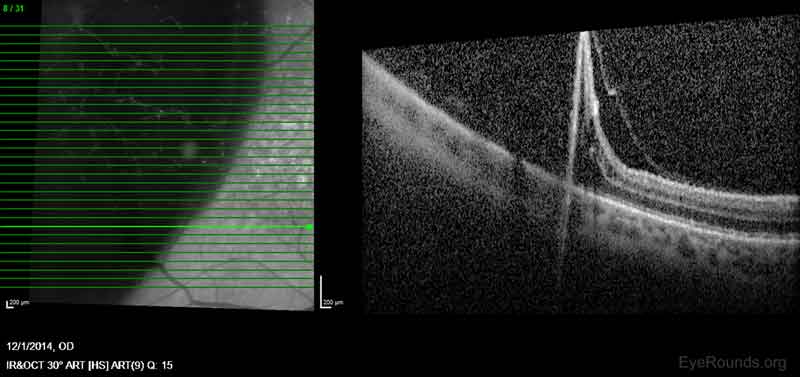 Figure 2: OCT image showing separation of the retina in the outer plexiform layer