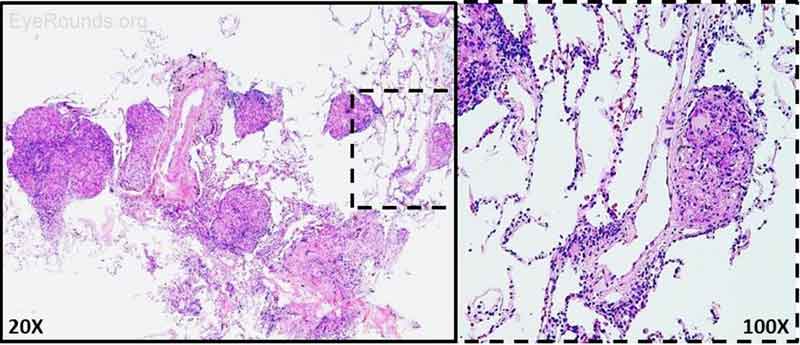 Figure 7: Right transbronchial biopsy. H&E staining of biopsied lung nodules revealed non-necrotizing granulomas. AFB and GMS stains were negative for microorganisms.