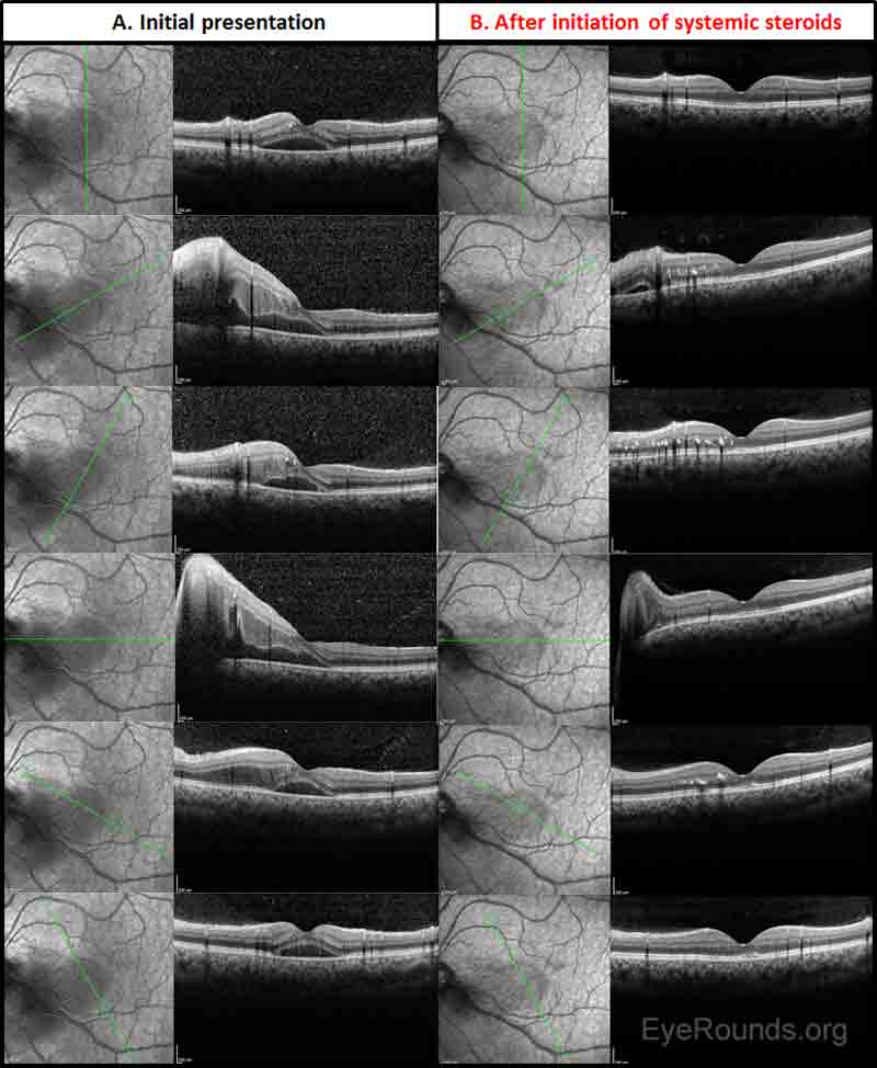 Figure 9: Serial optical coherence tomography (OCT) images. OCT images were obtained at initial presentation (Panel A) and after five weeks of prednisone therapy (Panel B). There was almost complete resolution of the subretinal fluid during this timeframe. Macular exudates were seen in the outer retina on follow-up. The patient's vision returned to 20/20 OU within the first month of treatment.