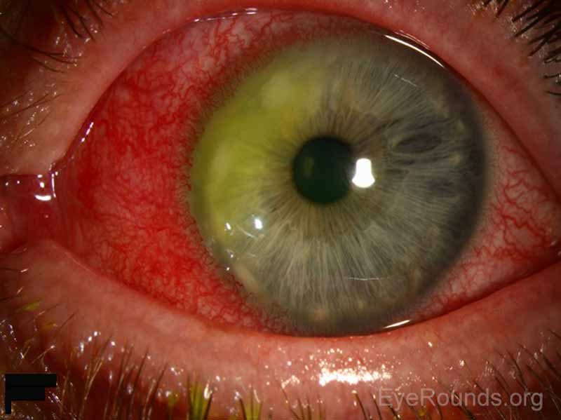 Figure 1: Slit lamp photographs of the left eye (A, B) showing a peripheral curvilinear infiltrate with ulceration superonasally separated from the limbus by a clear corneal zone. There is no obvious corneal thinning. There is associated conjunctival injection and vessel encroachment from the limbus.