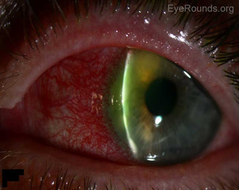 Figure 1: Slit lamp photographs of the left eye (A, B) showing a peripheral curvilinear infiltrate with ulceration superonasally separated from the limbus by a clear corneal zone. There is no obvious corneal thinning. There is associated conjunctival injection and vessel encroachment from the limbus. 