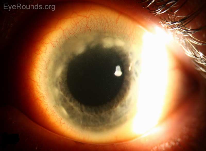 Figure 2. Slit lamp photographs of left eye (A, B) four days after presentation, which was after two days of treatment with topical prednisolone. Figure A shows progression of corneal infiltrates but overall improved appearance. Figure B shows that there is no corneal thinning at the previous area of ulceration.