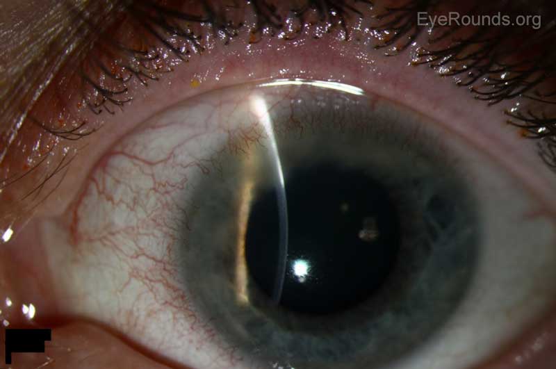 Figure 2. Slit lamp photographs of left eye (A, B) four days after presentation, which was after two days of treatment with topical prednisolone. Figure A shows progression of corneal infiltrates but overall improved appearance. Figure B shows that there is no corneal thinning at the previous area of ulceration.