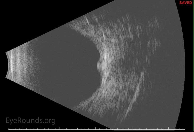 Figure 5: -B-scan echo showing superior shallow choroidal during post-operative course 