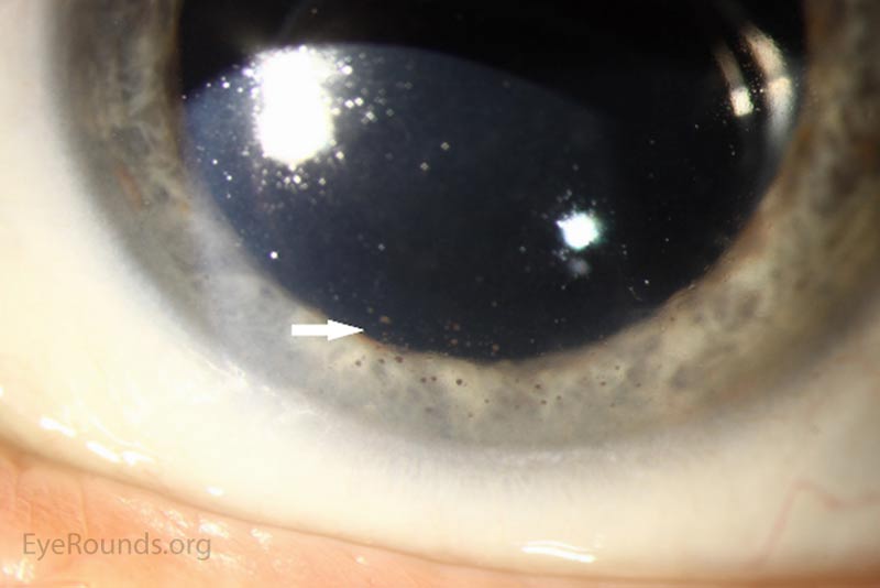 Figure 2: Slit Lamp photos of both eyes reveal pigmented keratitic precipitates (arrows) 