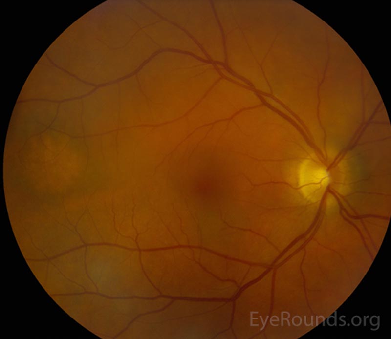 Figure 3: Fundus photos of both eyes. Right eye shows an amelanotic lesion in temporal macula. Left eye was normal. 