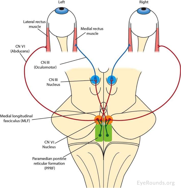 Figure 2. Schematic representation of MLF and associated structures. Damage to the MLF disrupts its ability to conduct high-frequency signals sent from the paramedian pontine reticular formation, resulting in slow adducting saccades. A loss of cross-talk between cranial nerve VI and cranial nerve III produces defects in conjugate eye movements that produce gaze. Image adapted from AAO's Basic and Clinical Science Course (BCSC) [2].