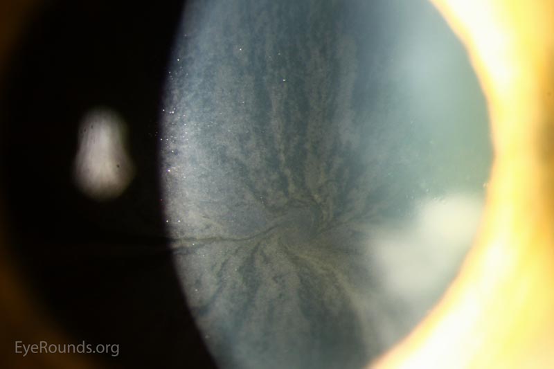 Slit lamp photos of the right eye exhibiting the whorled pattern of corneal verticillata