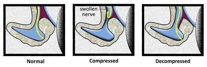 Schematic showing facial nerve decompression. Panel A shows a normal facial nerve within the Fallopian canal of the temporal bone. Panel B shows the facial nerve compressed within the labyrinthine segment of the Fallopian canal. Panel C shows the facial nerve after decompression of the labyrinthine segment of the Fallopian canal.