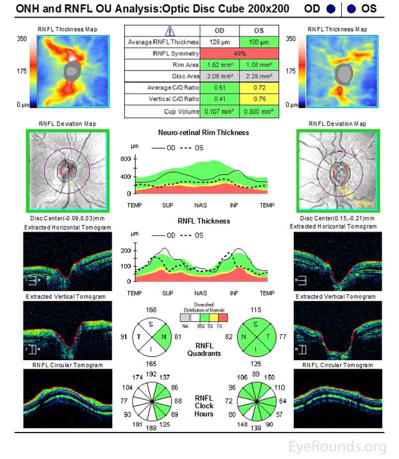 Figure 3: Optical coherence tomography (OCT) of the optic nerve head (ONH) of both eyes. Although the signal strength is poor (6/10 OD and 5/10 OS), the ONH OCT demonstrates robust retinal nerve fiber layer (RNFL) in both eyes. However, the RNFL of the left eye is relatively thinned compared to that of the right eye. There is glaucomatous cupping and a thin neuroretinal rim in the left eye when compared with the right eye. 