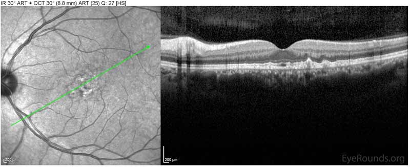 OCT OS Optical coherence tomography of both eyes. In both eyes, there are small drusen above Bruch's membrane without sub- or intraretinal fluid.