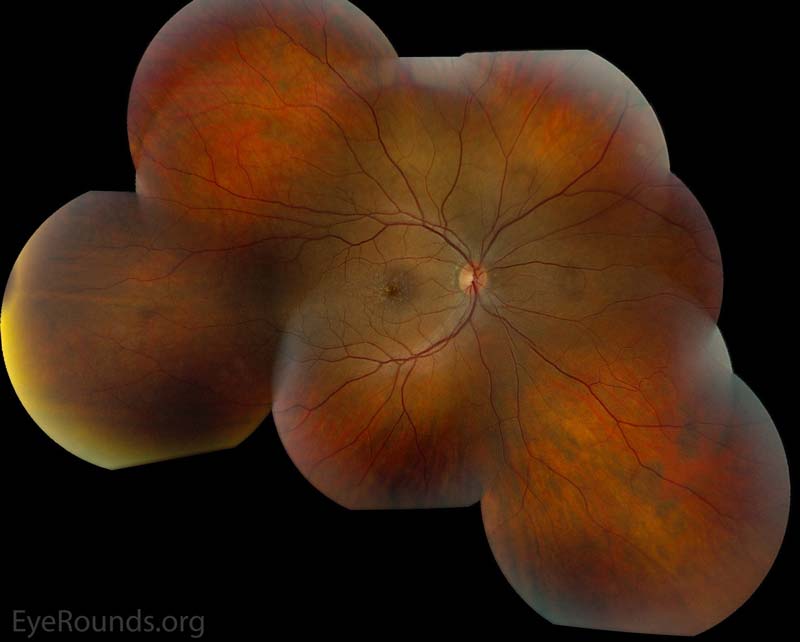 Color fundus photos centered on the macula and montage photos of both eyes. There were multiple small-medium sized, round, yellow drusen, some confluent in the macula and nasal to the nerve in both eyes. There was more clustering of drusen in the temporal macula. A few drusen were near, but not completely abutting the optic nerve. 