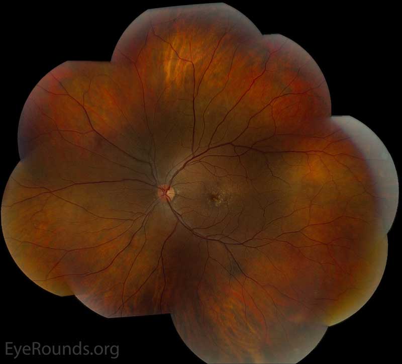 Color fundus photos centered on the macula and montage photos of both eyes. There were multiple small-medium sized, round, yellow drusen, some confluent in the macula and nasal to the nerve in both eyes. There was more clustering of drusen in the temporal macula. A few drusen were near, but not completely abutting the optic nerve. 