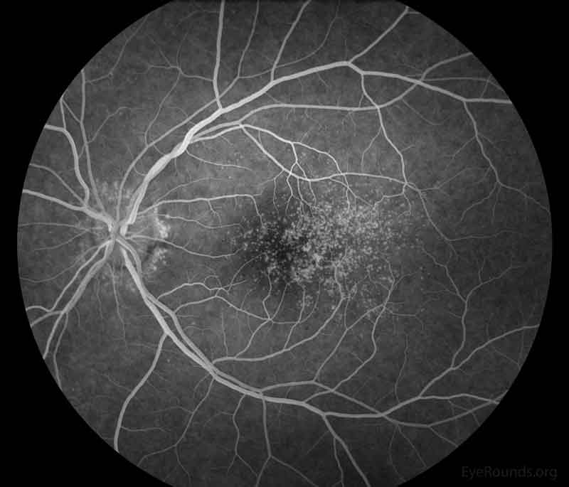 Representative fluorescein angiography photos of both eyes. There are more hyperfluorescent drusen than seen on fundoscopic exam.