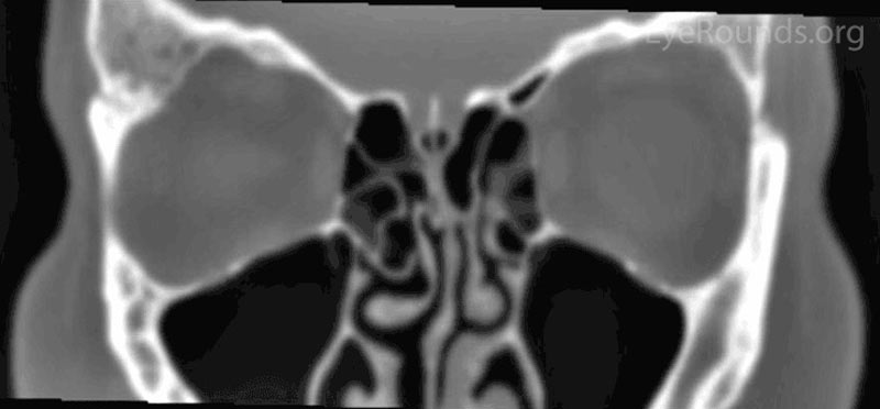 Figure 1: Orbital CT showing expansion of the right greater wing of the sphenoid bone with mottled appearance. (A: coronal view, B: axial view)