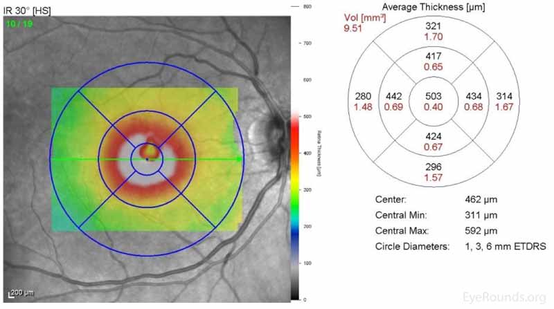 Spectralis ocular coherence tomography (OCT) of the macula OD on initial presentation demonstrating the presence of a full-thickness macular hole with interstitial and subretinal fluid. 