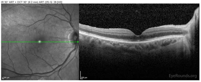 Spectralis OCT of the macula OD at the one-month post-operative visit demonstrating interval closure of the macular hole.  