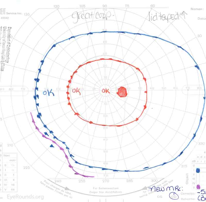 Goldmann visual field (A) OD showing a full field and (B) OS showing generalized constriction with only a small paracentral island of l2e remaining.