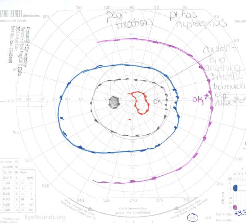 Goldmann visual field (A) OD showing a full field and (B) OS showing generalized constriction with only a small paracentral island of l2e remaining.