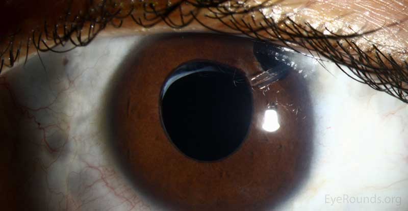 Slit lamp photograph demonstrating Baerveldt tube emerging anteriorly, through the iridectomy. 