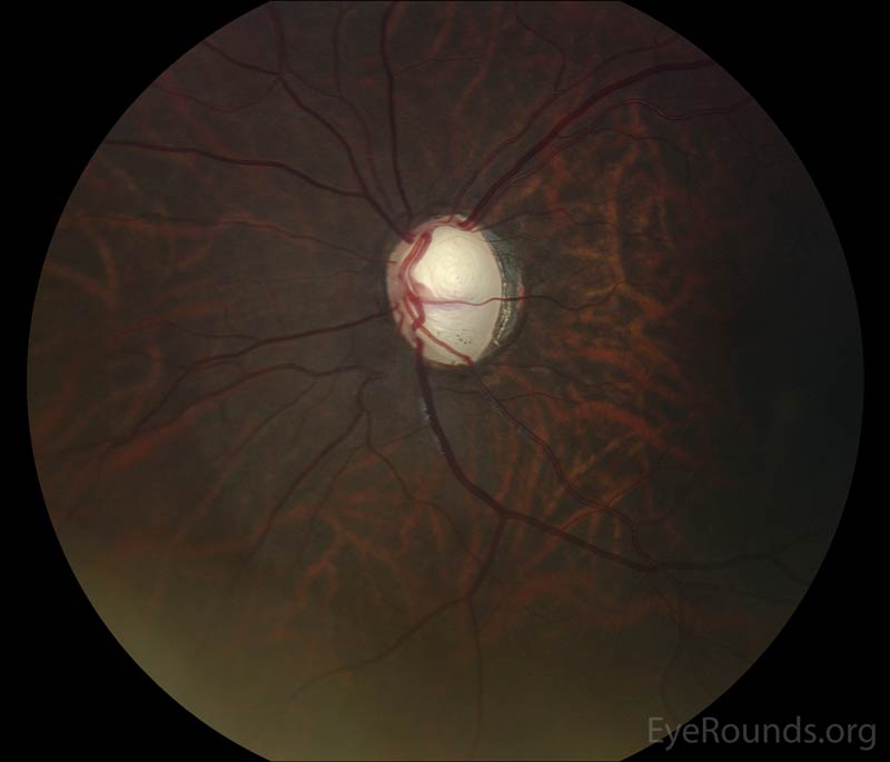 Color fundus photos of left eye (A) Cup-to-disc ratio of 0.9 at age 15 and (B) Cup-to-disc ratio of 0.9 at age 20.