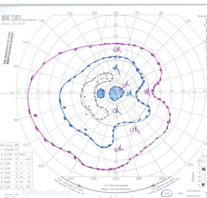 Goldmann visual field OS showing general constriction with superior and inferior arcuate scotomas, along with a central scotoma.