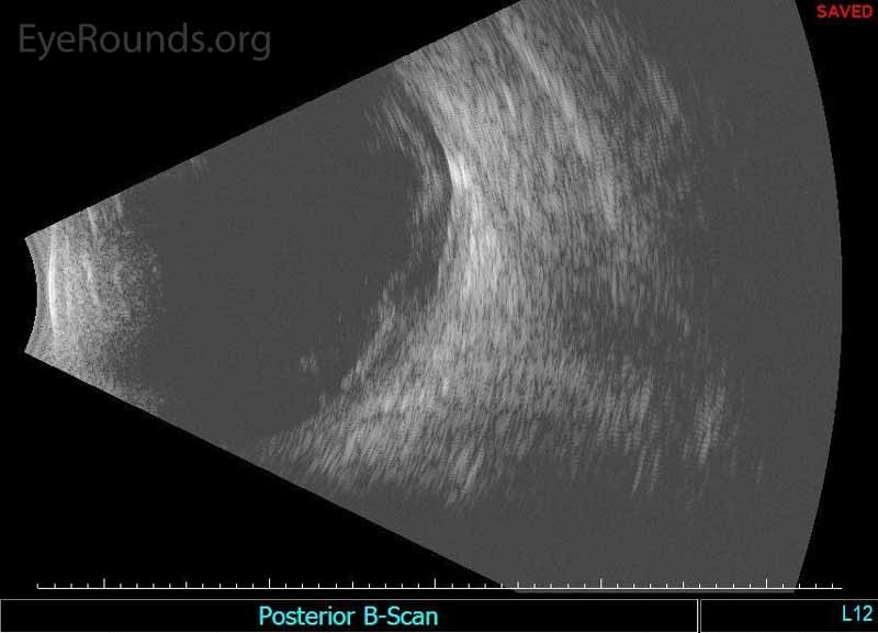 Echography of the right eye demonstrated dense irregular vitreous opacities that were concentrated posteriorly along the fundus and surrounding the optic disc. There was irregular retinochoroidal layer thickening. The retina was attached.