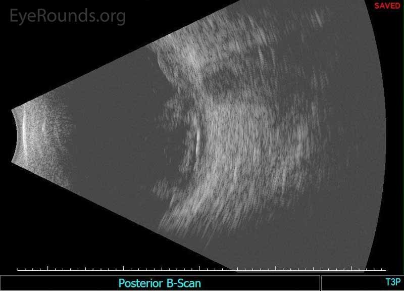 Echography of the right eye demonstrated dense irregular vitreous opacities that were concentrated posteriorly along the fundus and surrounding the optic disc. There was irregular retinochoroidal layer thickening. The retina was attached.