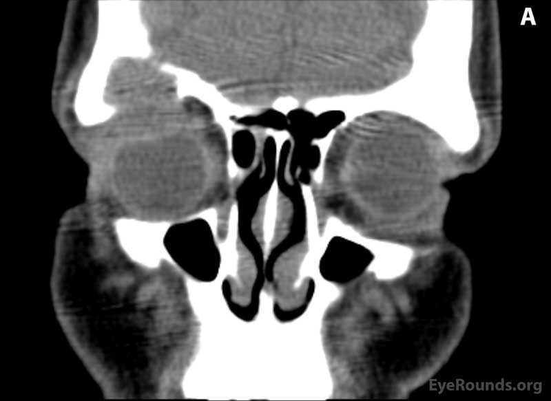 CT of orbits without contrast. (A) Coronal section