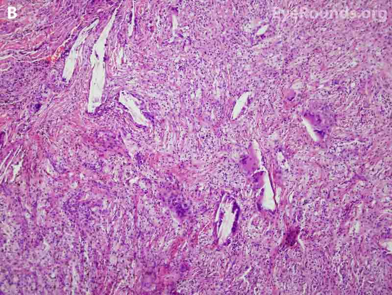 Hematoxylin-eosin stained histopathology demonstrating numerous cholesterol crystal clefts, surrounding multinucleate giant cells, epithelioid histiocytes, and foamy macrophages, all of which are consistent with a cholesterol granuloma; 10x magnification