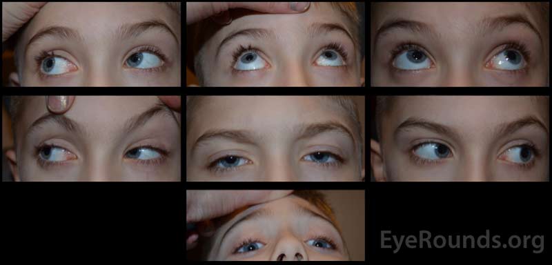 Gaze photos demonstrating excellent post-operative alignment in all gazes three months after bilateral medial rectus botulinum toxin injections. 