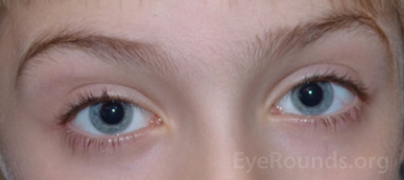 This patient achieved excellent alignment, shown at post-operative month five and maintained through one year post-operatively. 